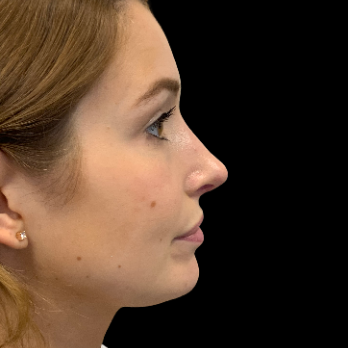 Ultrasonic-rhinoplasty-after